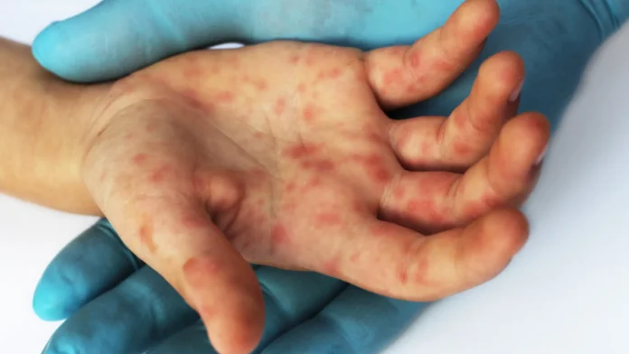 Surto de sarampo deixa 2 mortos e mais de 200 doentes nos EUA