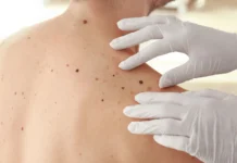 Casos de câncer de pele saltam de 4 mil para mais de 72 mil em 10 anos