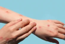 Brasil chega a 140 casos confirmados de mpox em 2026