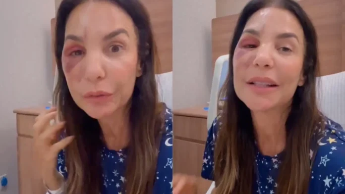 Ivete Sangalo faz cirurgia para corrigir fratura no maxilar após queda