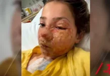 Menina de 10 anos sofre queimaduras no rosto após fazer desafio do TikTok
